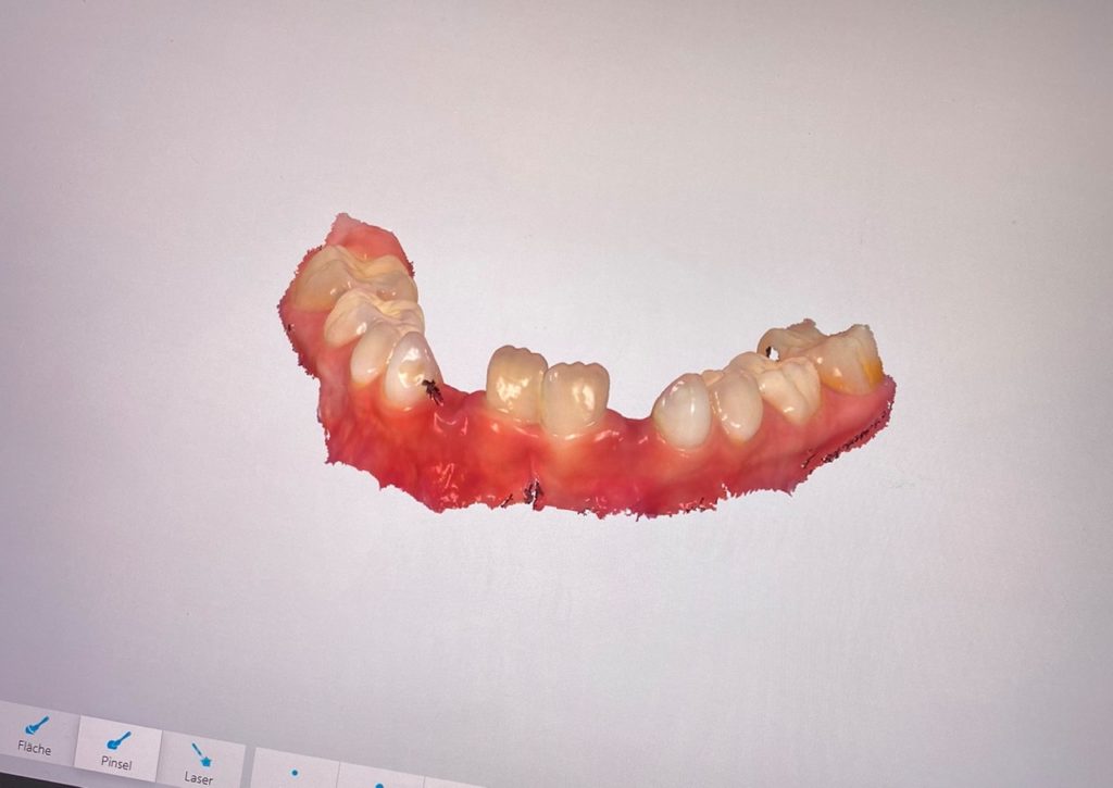 3D-Scan von einem Unterkiefer mit zwei Zahnlücken